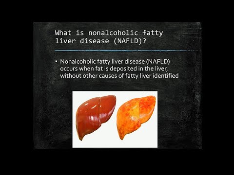 Fatty Liver: The Silent Epidemic